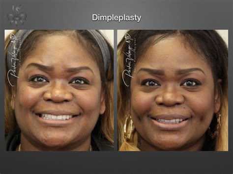 plastic surgery for dimples.